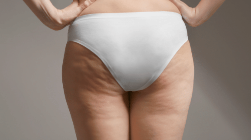 woman with cellulite on thighs and butt featured